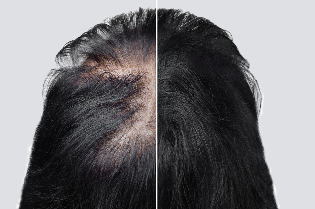 Male Pattern Baldness in Women: Understanding Androgenetic Alopecia