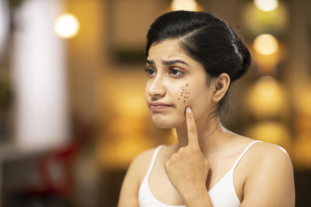 How to deal with the aftermath of over-exfoliated skin